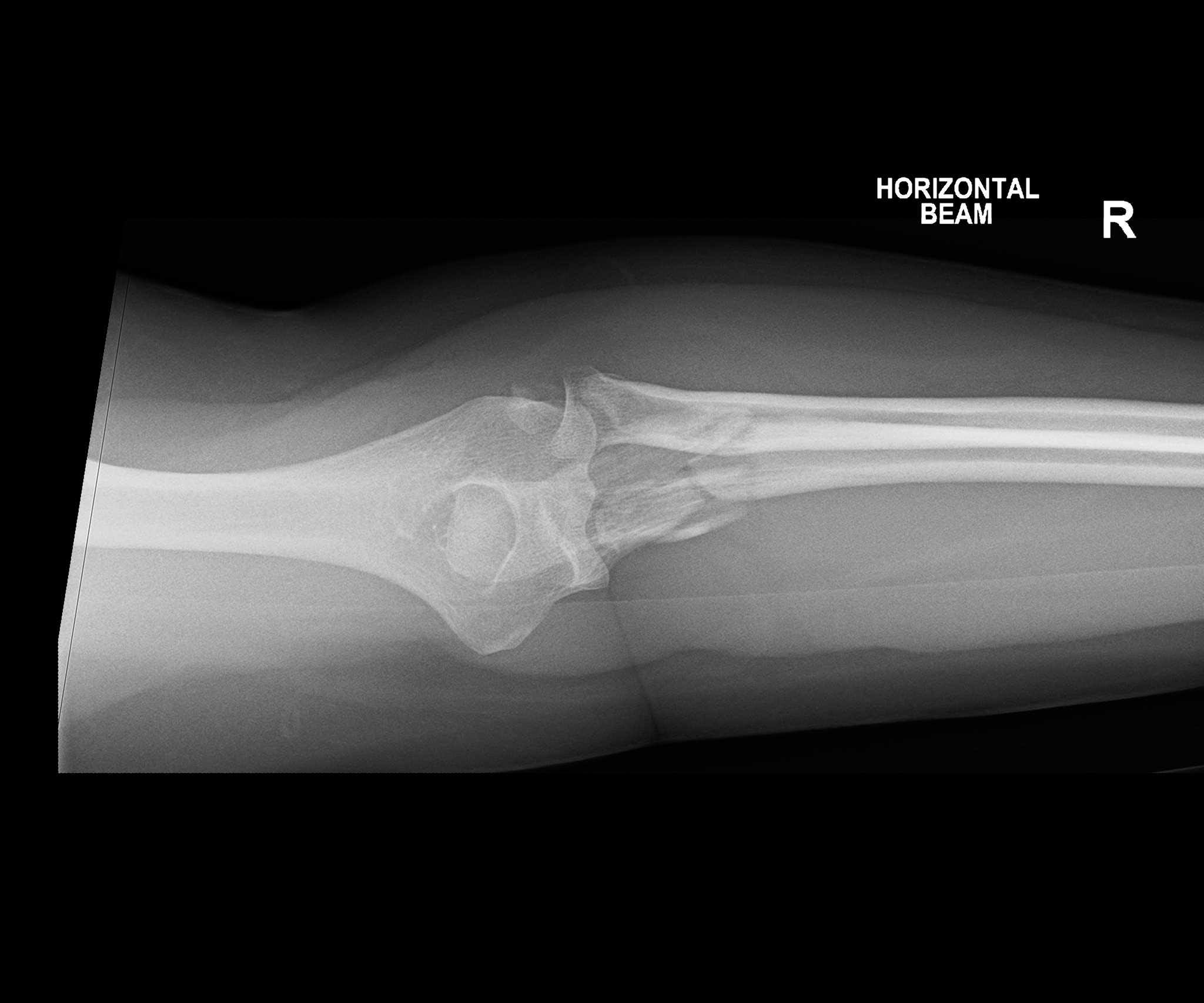 Ange's arm in a brace, taken during the early weeks of recovery.