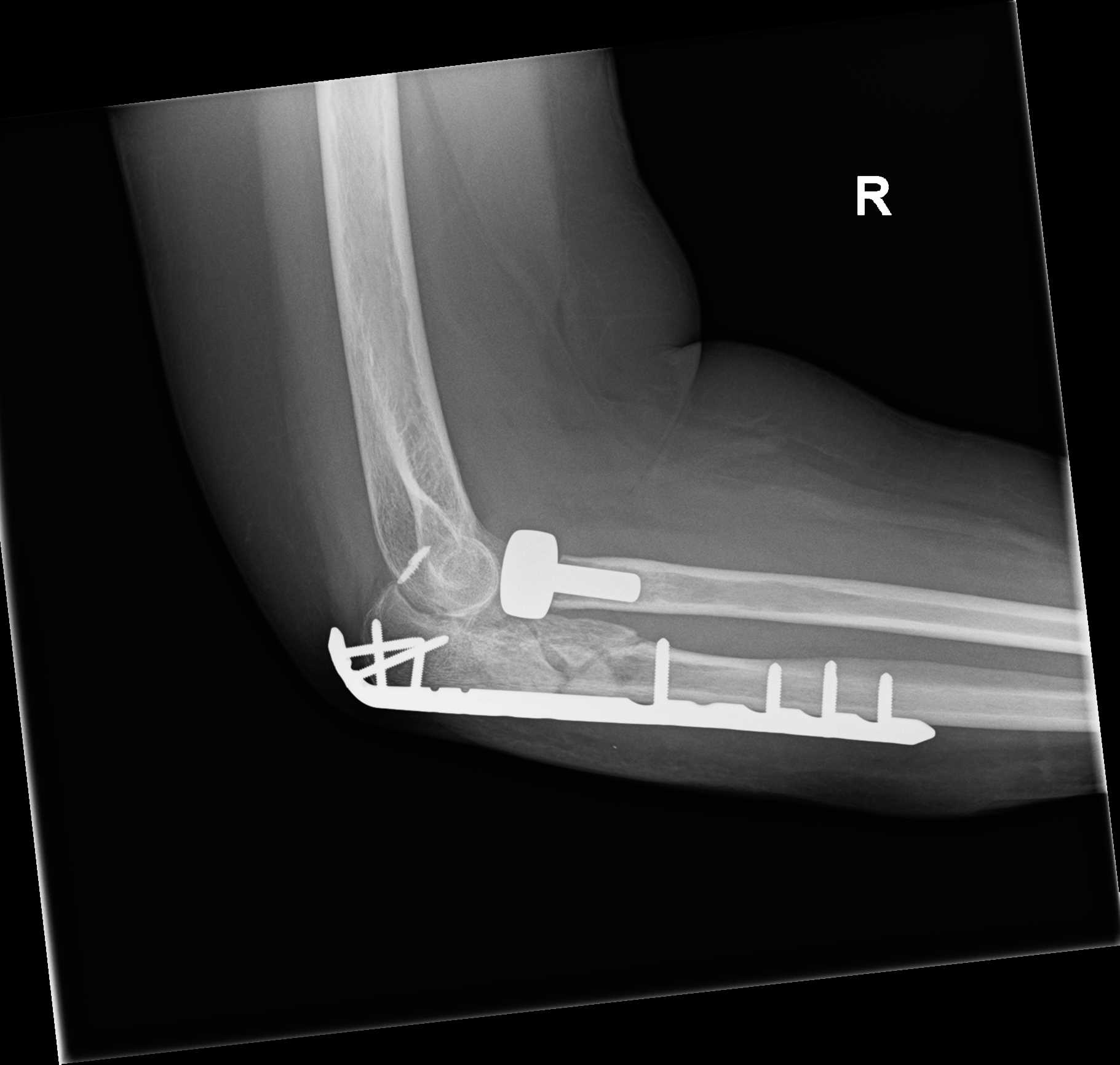 Lateral elbow X-ray from 7 February 2022, after further surgery.