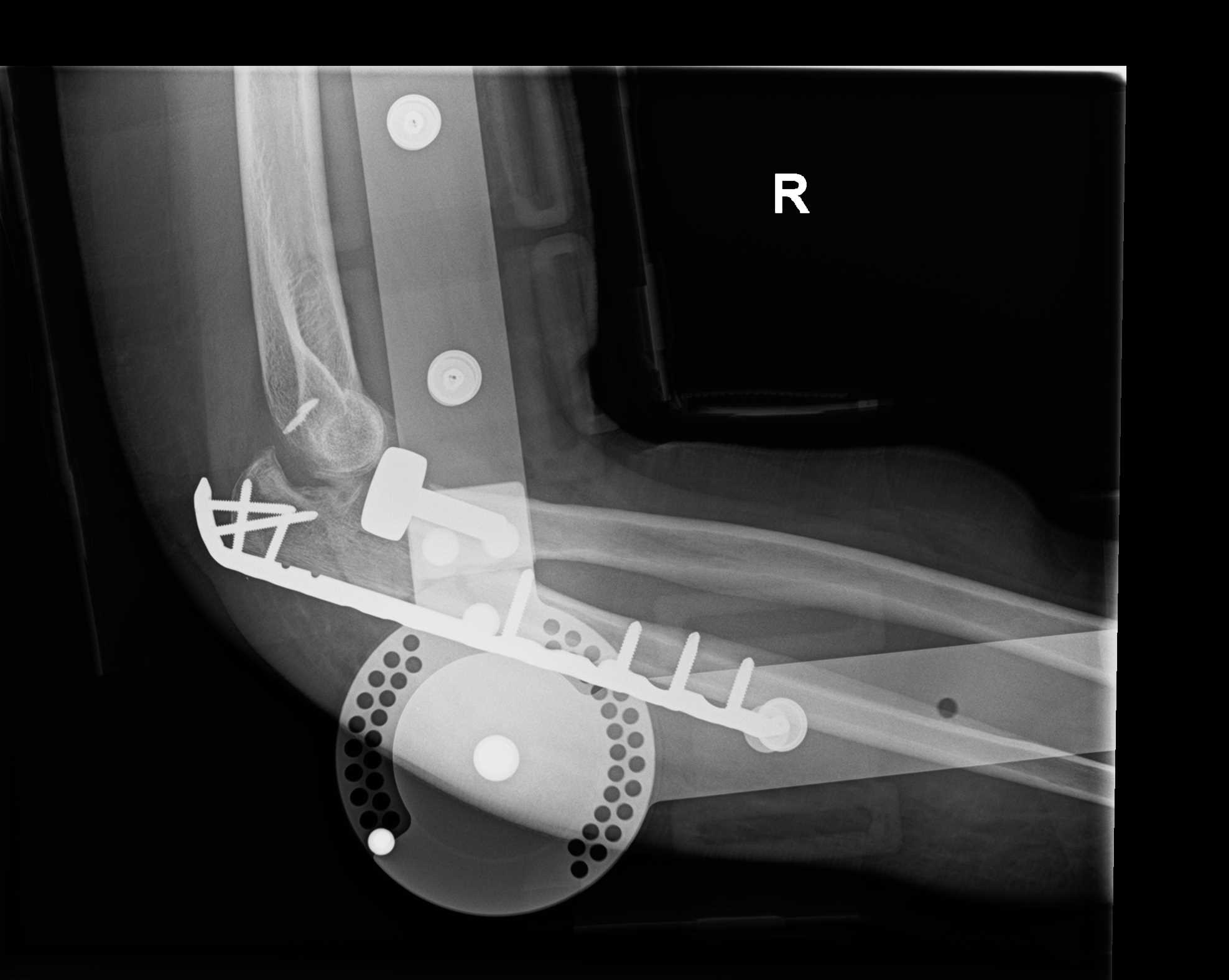 Lateral elbow X-ray from 11 October 2021, after the first surgery.
