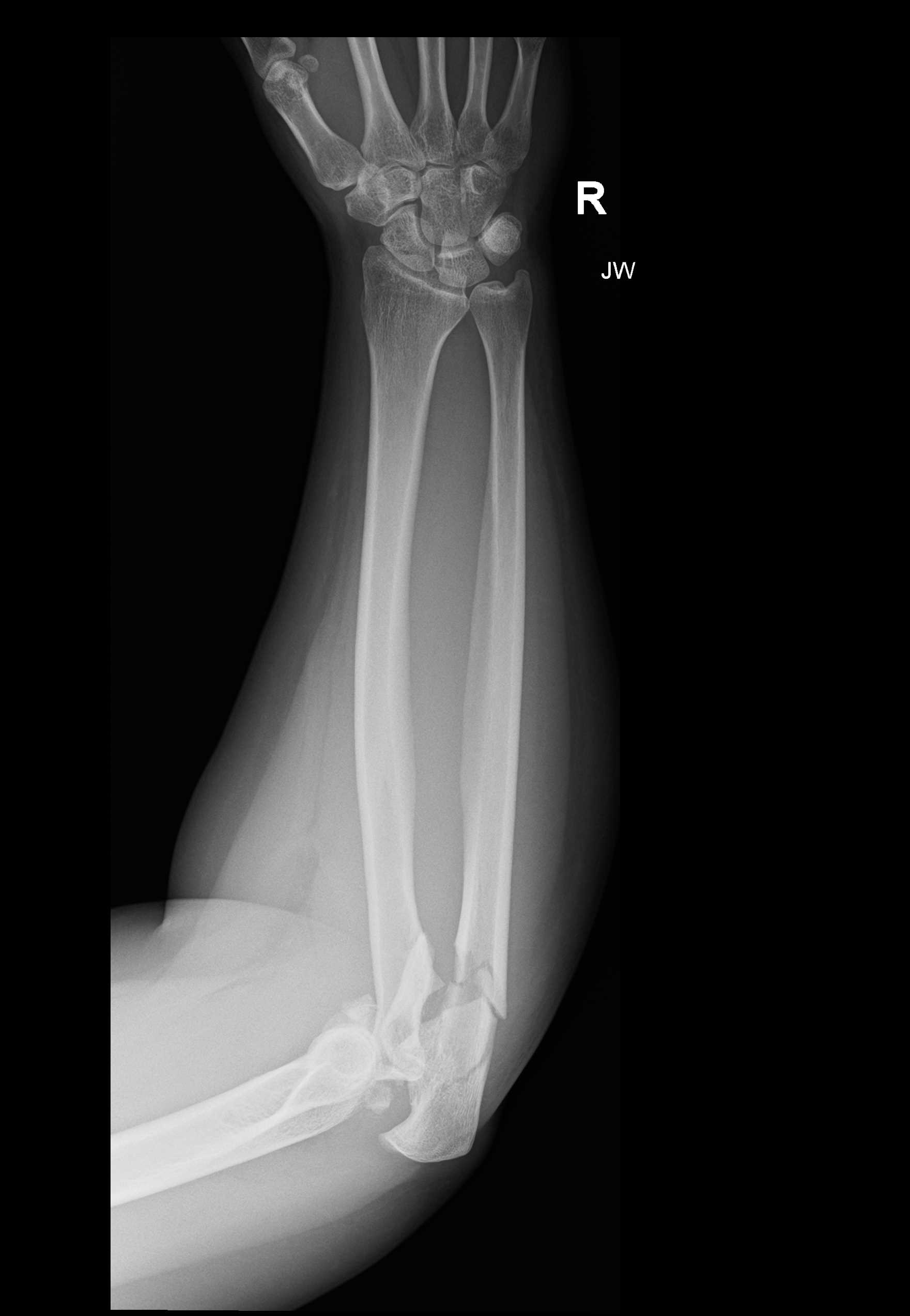 X-ray taken on 11 August 2021, the day of the injury.