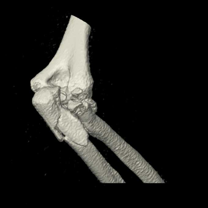 CT scan slice from 11 August 2021 showing the extent of the elbow injury.