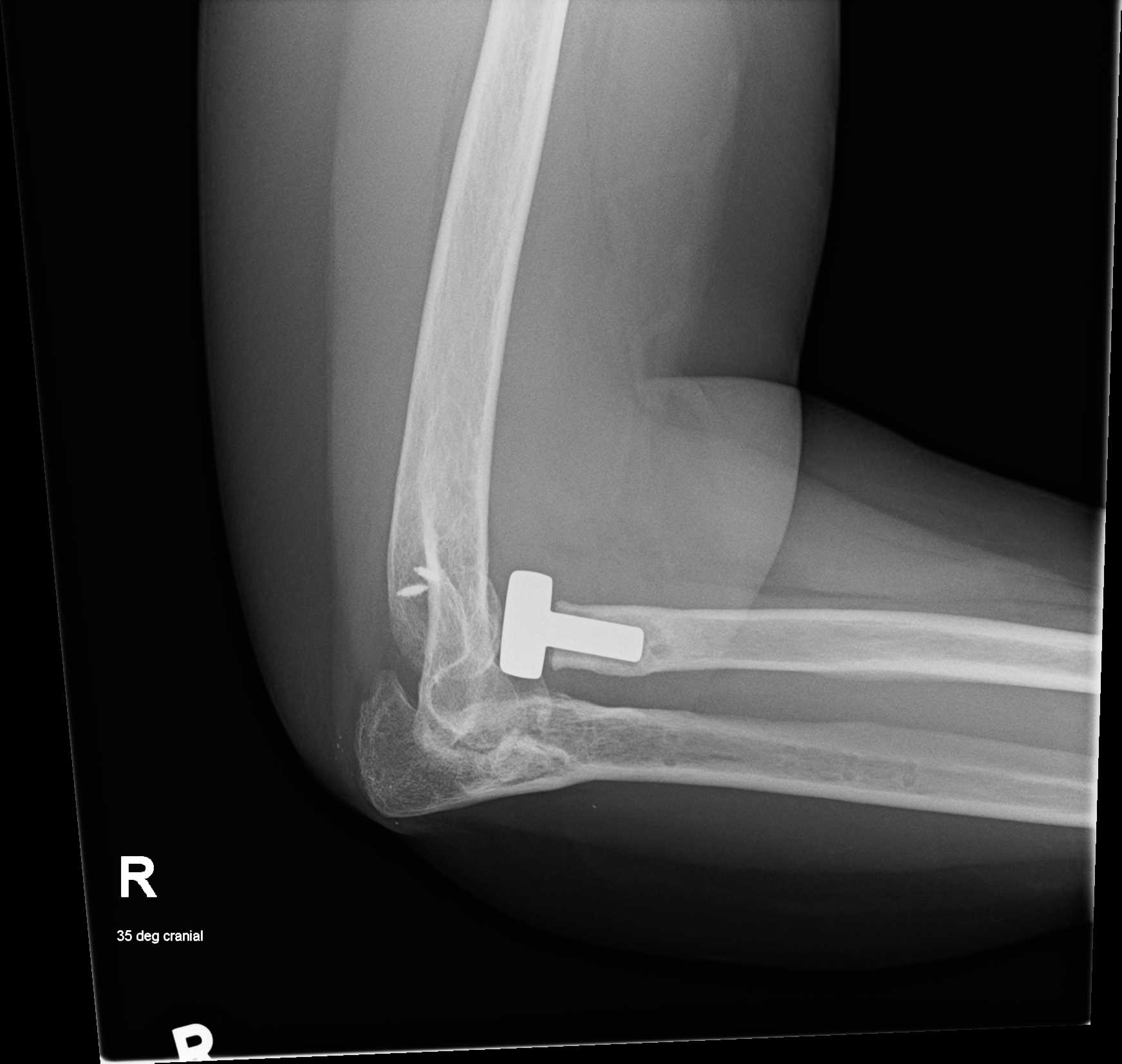 Lateral elbow X-ray from 20 November 2023, after the third and final surgery.